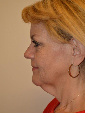 Facelift and Necklift Case 5002 Before Photo Facelift and Necklift
