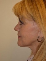 Facelift and Necklift