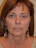 Facelift and Necklift