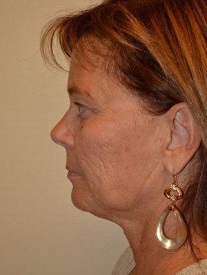 Facelift and Necklift Case 5019 Before Photo Facelift and Necklift