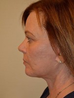 Facelift and Necklift