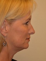 Facelift and Necklift