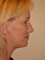 Facelift and Necklift