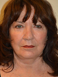 Facelift and Necklift Case 5037 After Photo Facelift and Necklift