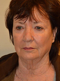 Facelift and Necklift Case 5037 Before Photo Facelift and Necklift