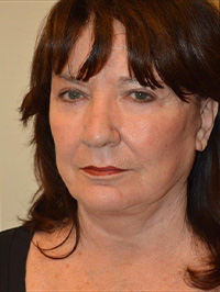 Facelift and Necklift Case 5037 After Photo Facelift and Necklift