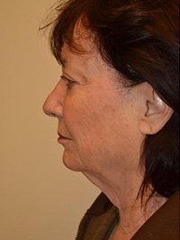 Facelift and Necklift Case 5037 Before Photo Facelift and Necklift