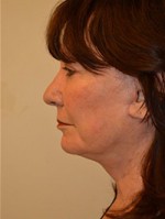 Facelift and Necklift