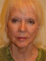 Facelift and Necklift