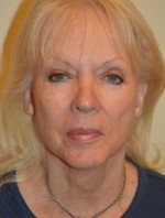 Facelift and Necklift