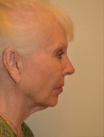 Facelift and Necklift