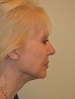 Facelift and Necklift