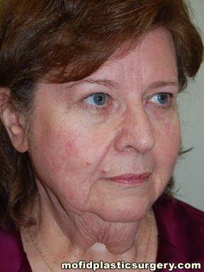 Facelift and Necklift Case 5053 Before Photo Facelift and Necklift