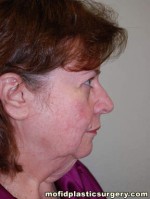 Facelift and Necklift