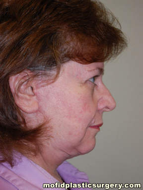 Facelift and Necklift Case 5053 After Photo Facelift and Necklift