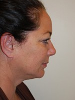 Facelift and Necklift