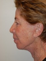 Facelift and Necklift