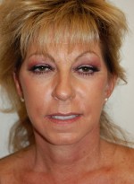 Facelift and Necklift