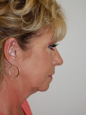 Facelift and Necklift