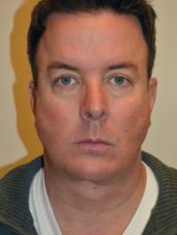 Facelift and Necklift Case 5127 After Photo Facelift and Necklift