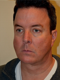 Facelift and Necklift Case 5127 After Photo Facelift and Necklift