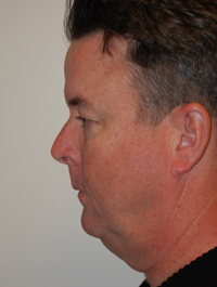 Facelift and Necklift Case 5127 Before Photo Facelift and Necklift