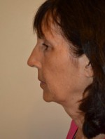 Facelift and Necklift