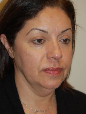 Facelift and Necklift Case 5143 Before Photo Facelift and Necklift