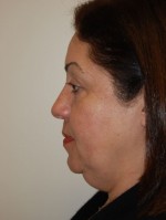 Facelift and Necklift