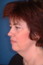 Facelift and Necklift