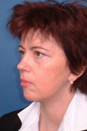 Facelift and Necklift Case 5152 After Photo Facelift and Necklift