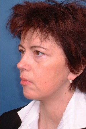 Facelift and Necklift