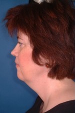 Facelift and Necklift