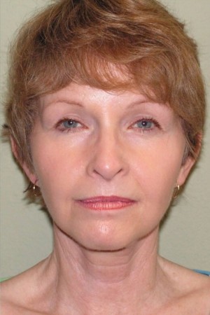 Facelift and Necklift