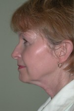 Facelift and Necklift