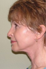 Facelift and Necklift