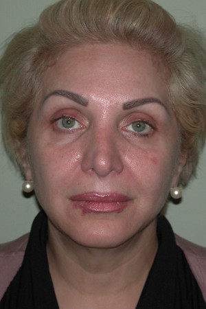 Facelift and Necklift Case 5171 Before Photo Facelift and Necklift