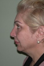 Facelift and Necklift