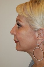 Facelift and Necklift