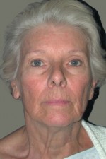 Facelift and Necklift