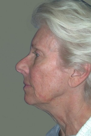Facelift and Necklift Case 5179 Before Photo Facelift and Necklift