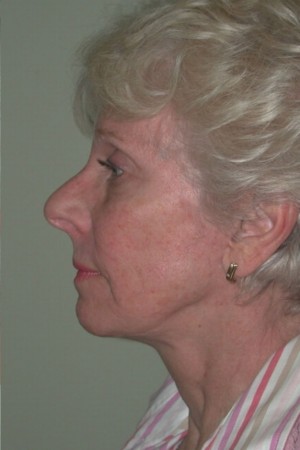 Facelift and Necklift Case 5179 After Photo Facelift and Necklift