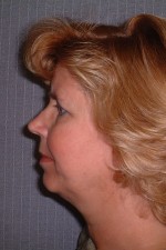 Facelift and Necklift