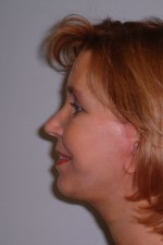 Facelift and Necklift