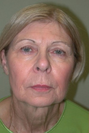 Facelift and Necklift Case 5207 Before Photo Facelift and Necklift