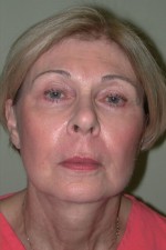 Facelift and Necklift