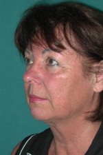 Facelift and Necklift