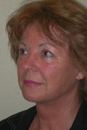 Facelift and Necklift Case 5219 After Photo Facelift and Necklift