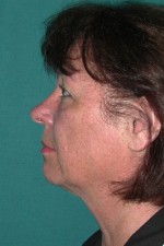 Facelift and Necklift