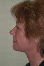 Facelift and Necklift